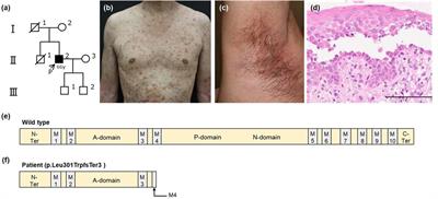 Late-onset Hailey-Hailey disease with a novel frame-shift variant in the ATP2C1 gene